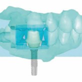 CAD/CAM in der Zahnarztpraxis – Fallbericht: CEREC Versorgung nach Implantation