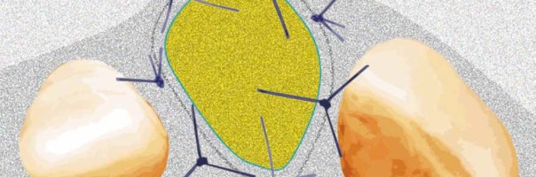 Implantation in der ästhetisch sensiblen Zone