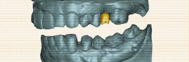 Rückwärts denken – digitaler Workflow mit Simplant und dem Astra Tech Implant System EV