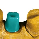 Versorgung mit implantat- und zahngestützten Einzelkronen im digitalen Workflow