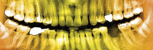 Prothetische Stützung des Weichgewebes bei Implantatfreilegung