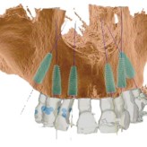 Sofortversorgung des kompletten Oberkiefers mit dem Straumann® Pro Arch Konzept