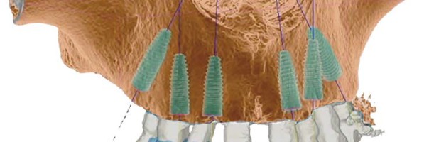 Sofortversorgung des kompletten Oberkiefers mit dem Straumann® Pro Arch Konzept