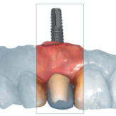 CAD/CAM-gefertigte, zweiteilige Implantatrehabilitation in der Front
