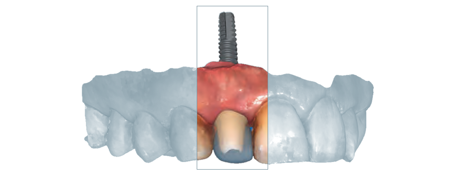 CAD/CAM-gefertigte, zweiteilige Implantatrehabilitation in der Front