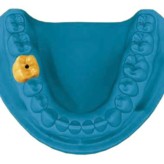 Digitaler Workflow als sicheres Konzept in der Implantologie: Implantatprothetische Versorgung einer Einzelzahnlücke im Seitenzahnbereich