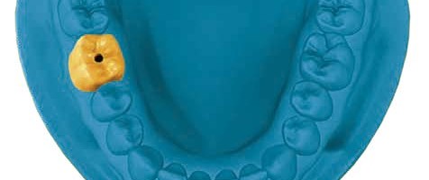 Digitaler Workflow als sicheres Konzept in der Implantologie: Implantatprothetische Versorgung einer Einzelzahnlücke im Seitenzahnbereich