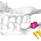 Minimalinvasive Implantatversorgung von Freiendsituationen im Unterkiefer mit wurzelidentischen Replicate-Implantaten