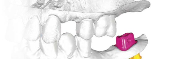 Minimalinvasive Implantatversorgung von Freiendsituationen im Unterkiefer mit wurzelidentischen Replicate-Implantaten