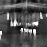 Mit Intraoralscannern zur digitalen Implantologie