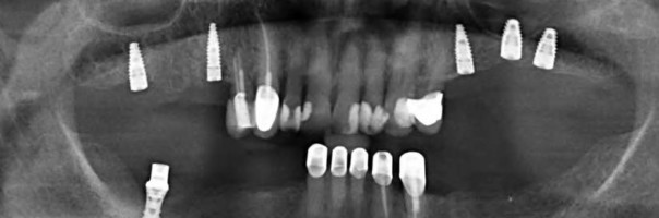 Mit Intraoralscannern zur digitalen Implantologie