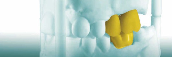 Schonend und effizient dank digitaler Implantationsplanung, navigierter Implantation und dem digitalen One Abutment – One Time Konzept