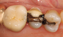 Abb. 1: Fraktur Zahn 25