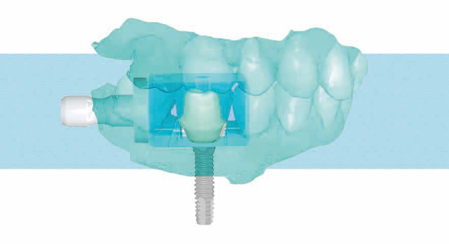 CAD/CAM in der Zahnarztpraxis – Fallbericht: CEREC Versorgung nach Implantation