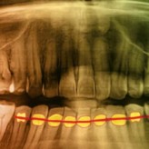Das dreiflächige Seitenzahnveneer – neue Wege bei der individuellen Versorgung erosions- und funktionsbedingter Zahnschäden bei Bruxismuspatienten