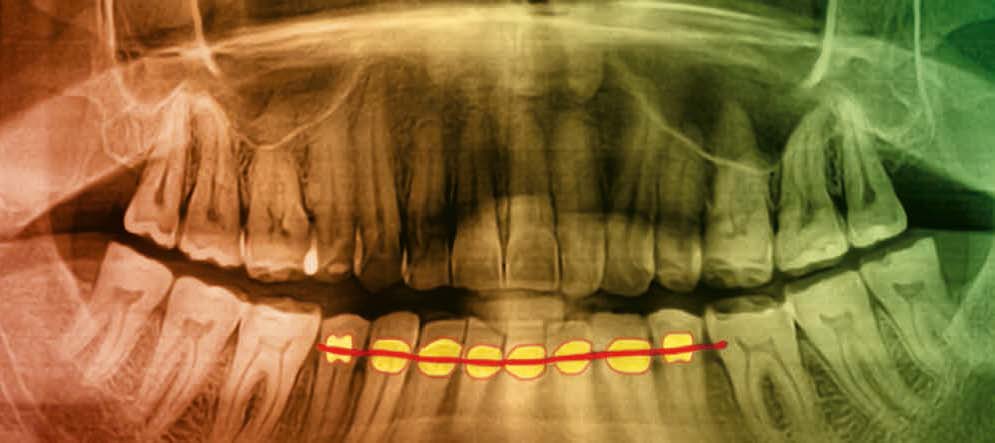 Das dreiflächige Seitenzahnveneer – neue Wege bei der individuellen Versorgung erosions- und funktionsbedingter Zahnschäden bei Bruxismuspatienten