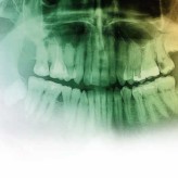 Digitale Volumentomographie im klinischen bewährten Endodontiekonzept bei komplexer Wurzelanatomie