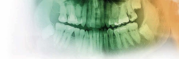 Digitale Volumentomographie im klinischen bewährten Endodontiekonzept bei komplexer Wurzelanatomie