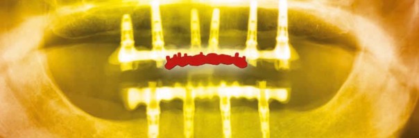 Geführte Chirurgie und Sofortbelastung nach zehn Jahren