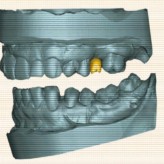 Rückwärts denken – digitaler Workflow mit Simplant und dem Astra Tech Implant System EV