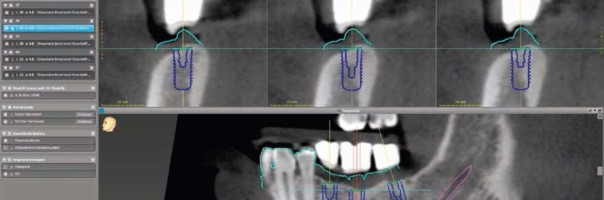 Sichere Implantation – coDiagnostiX aus Anwendersicht