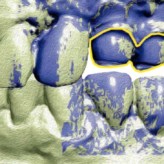 Versorgung eines Patienten mit implantat- und zahngetragenen Vollkeramikkronen und einer implantatgetragenen Brücke mit makroretentiven Keramikkronen