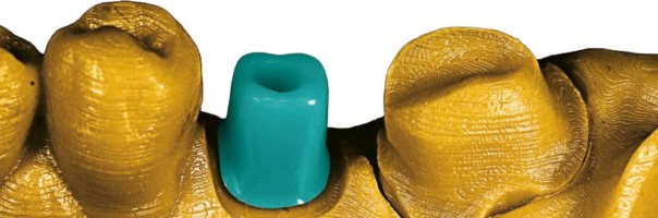 Versorgung mit implantat- und zahngestützten Einzelkronen im digitalen Workflow