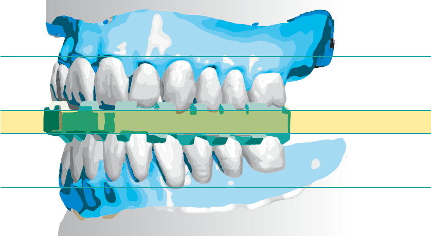 Mit Digital Denture Professional gefertigte Totalprothesen: Ein Patientenbeispiel