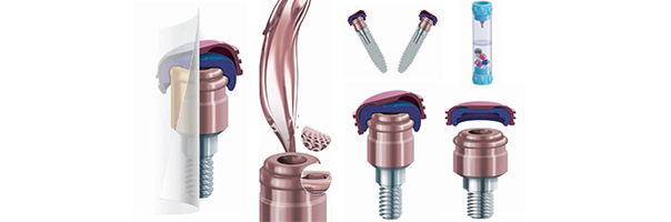 LOCATOR R-Tx™ – implantatgetragener Zahnersatz, leicht in der Handhabung